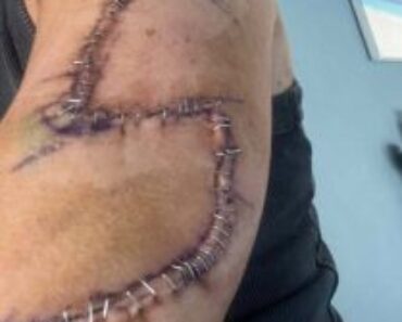 Mom Gets 77 Stitches in Arm After She Ignores a ‘Normal’ Mole – WowNews.info