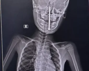 HT13. 7-Year-Old Boy Gets 3