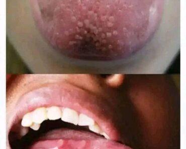 If you have pimples on your tongue, your body is warning you about something very important.