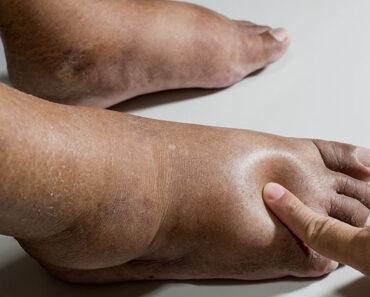 Reveal the Shocking Kitchen Item Causing Your Edema—Hint: It’s Not Salt! – Daily News