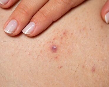 HT13. All the Symptoms of Stomach Cancer – Daily News