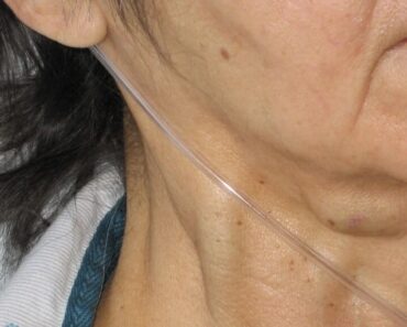 HT13. Massive jugular vein distension: a sign not to be ignored See More – Daily News