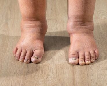 HT13. Health Warning Signs on Your Feet You Should Never Ignore – Daily News