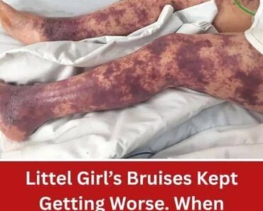 Little Girl’s Bruises Kept Getting Worse. When Mom Found Out The Truth, It Was Too Late…! – readtime.store