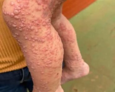 His whole body was itchy, he thought it was an allergy and was diagnosed…See more