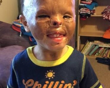 Foster baby is adopted 7 years after apartment fire left him with horrific burns