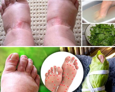 8 Natural Remedies to Soothe Swollen Legs and Joint Inflammation