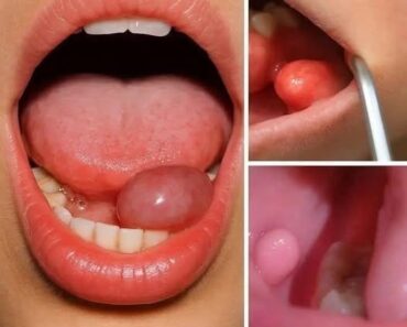 HT9. These are the first symptoms of a… –