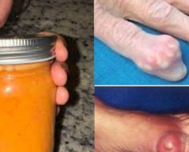 Benefits of This Ingredient to Eliminate Gout and Uric Acid.