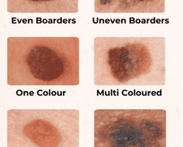 Be Very Careful: If You Notice This Skin Growth, It Could Be Serious – Daily News
